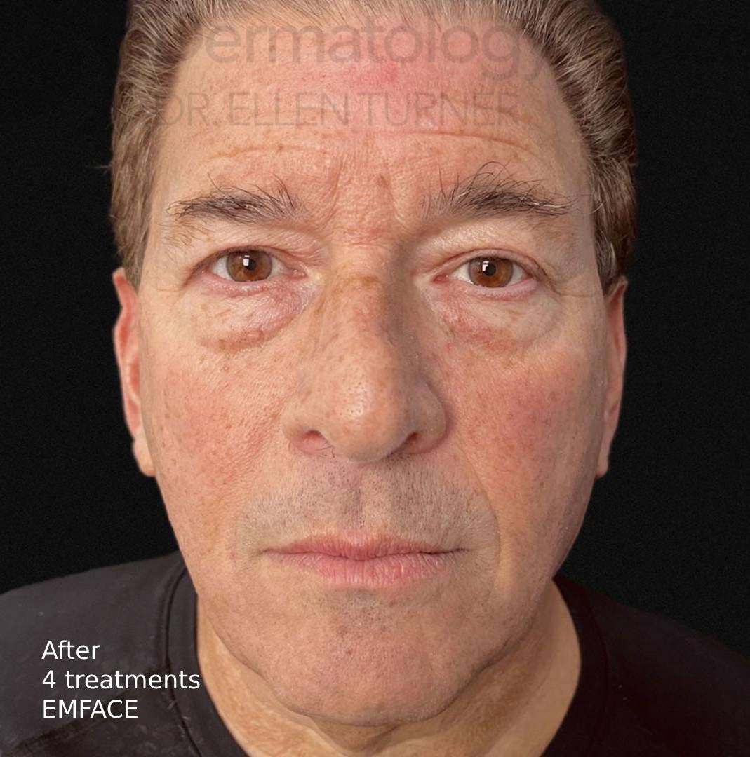 EMFACE (4 treatment) Before and After Case-20 After