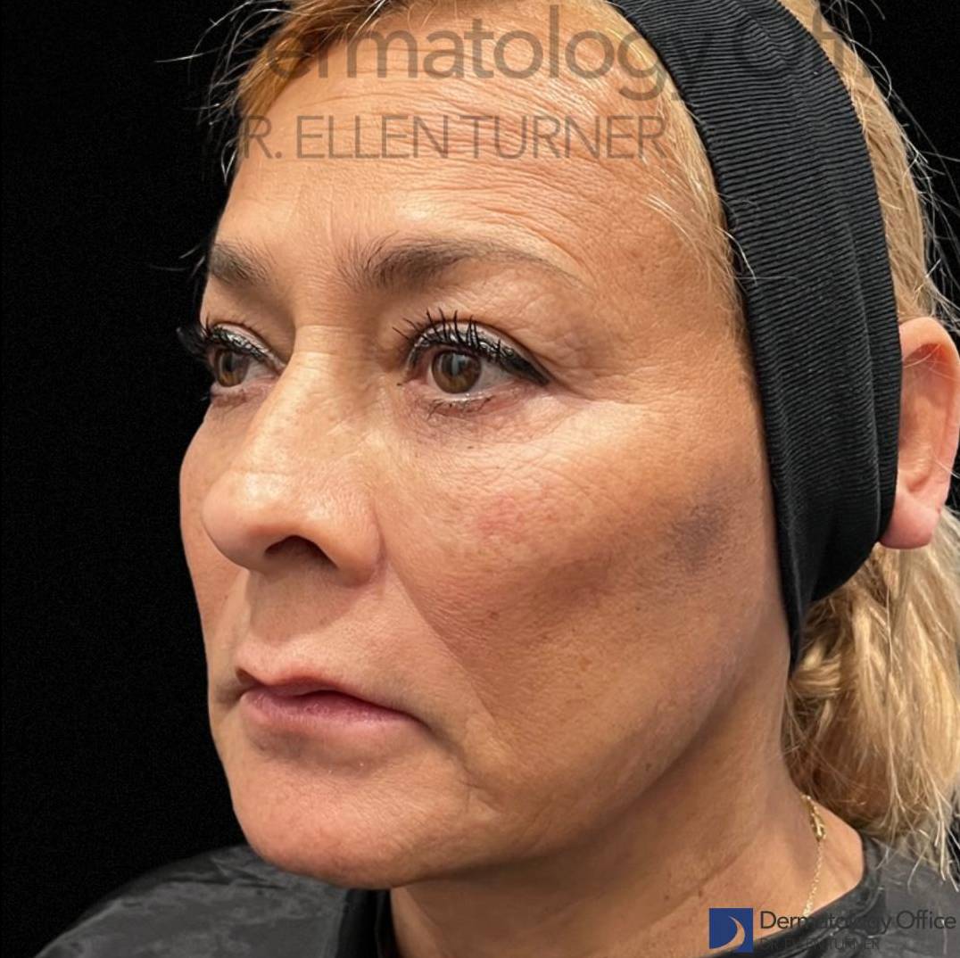 EMFACE (1 treatment) Before and After Case-25 After