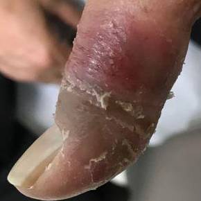 Allergic Contact Dermatitis Before and After Case 2 Before