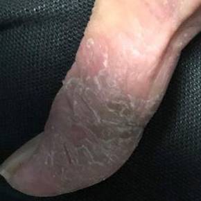 Allergic Contact Dermatitis Before and After Case 2 After