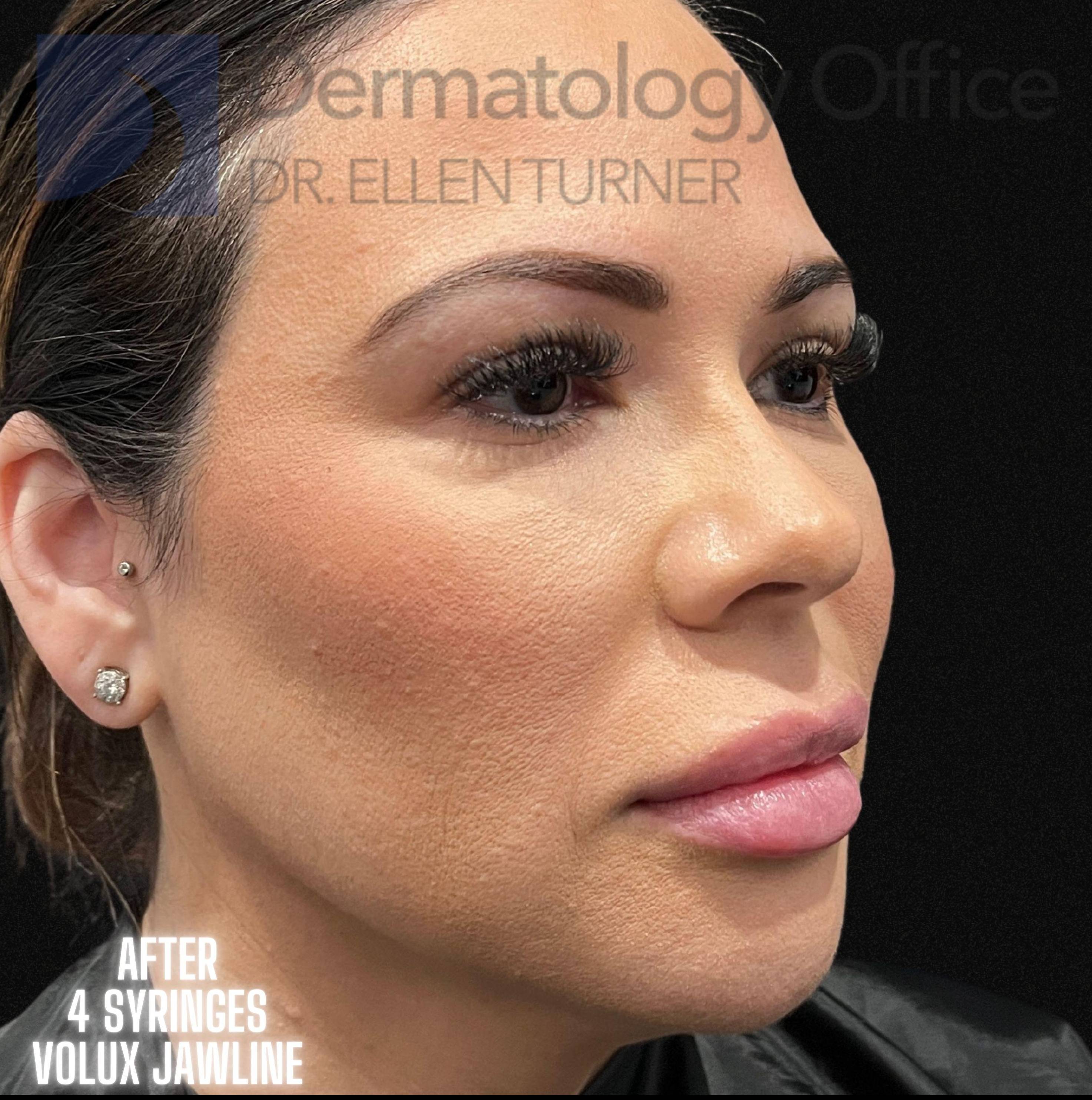 Volux (4 syringes) Before and After Case -3 After
