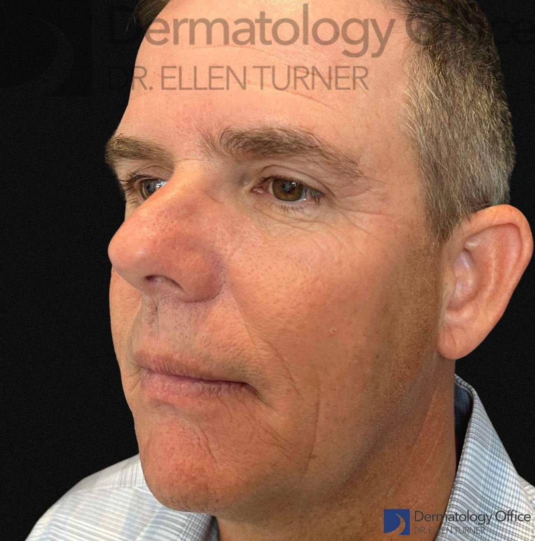 EMFACE (4 treatments) Before and After Case-31 Before