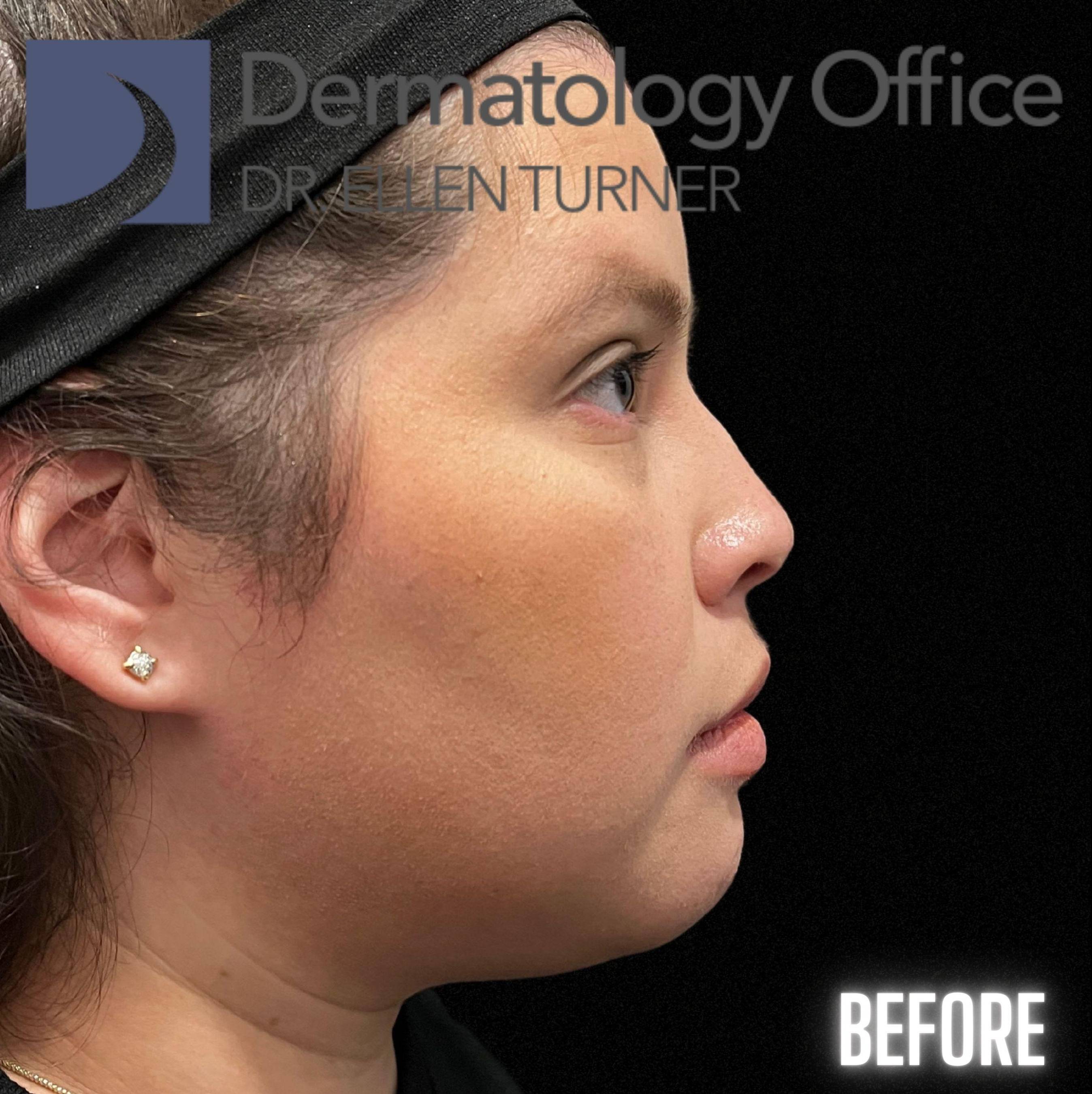 Volux (4 syringes) Before and After Case -12 Before