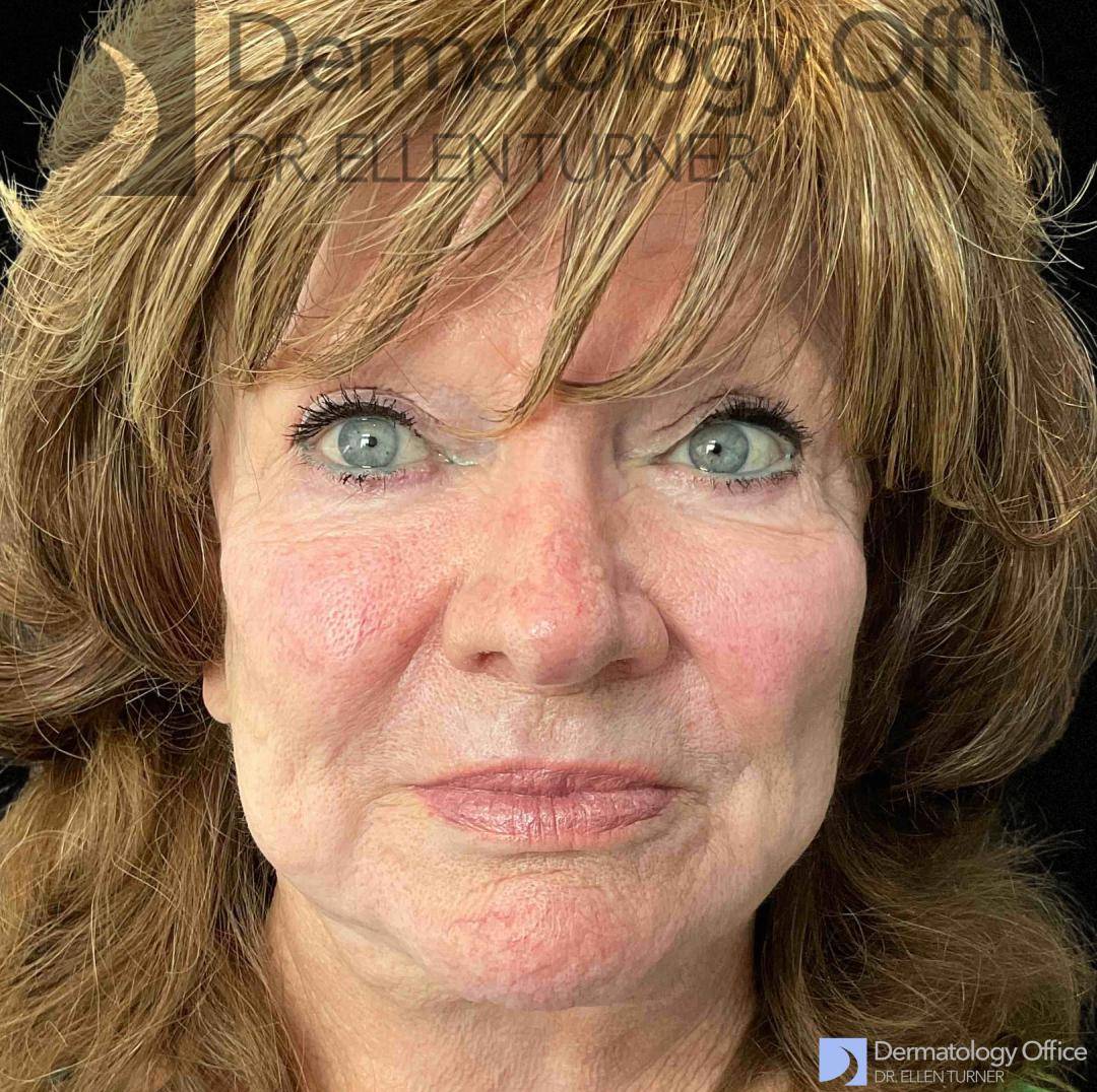 EMFACE (4 treatments) Before and After Case-35 After