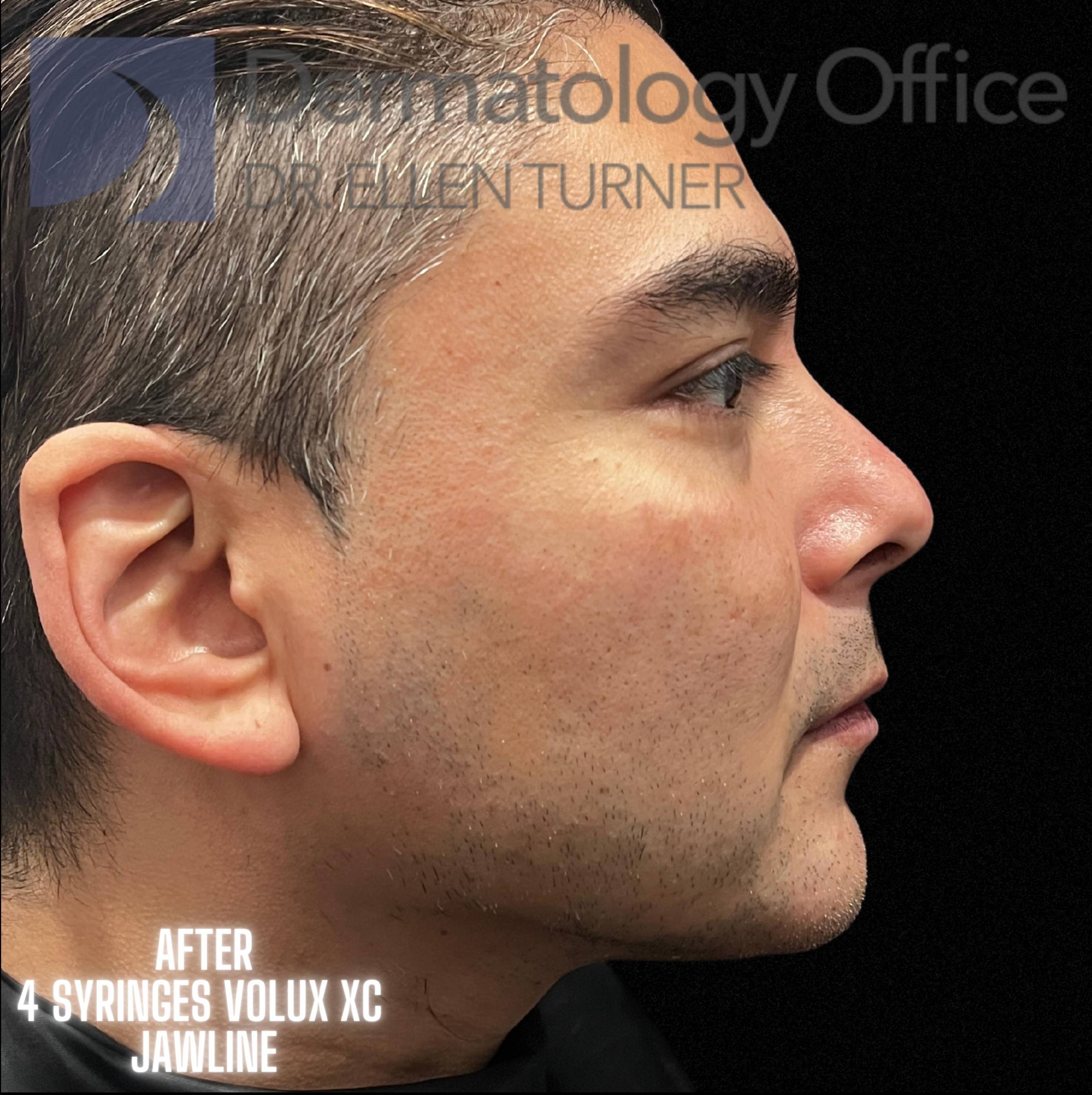 Volux (4 syringes) Before and After Case -17 After