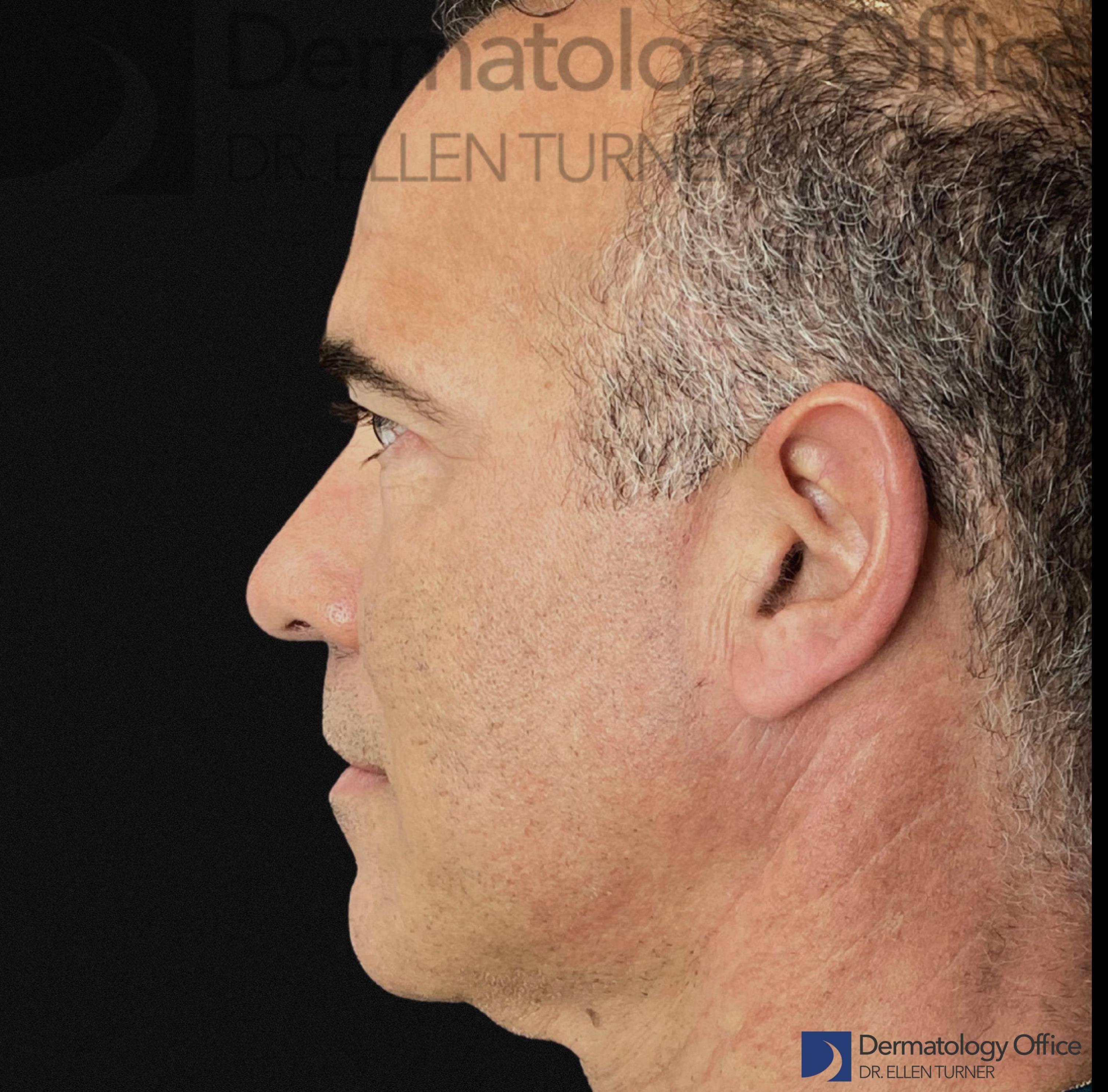 EMFACE (4 treatments) Before and After Case-46 Before