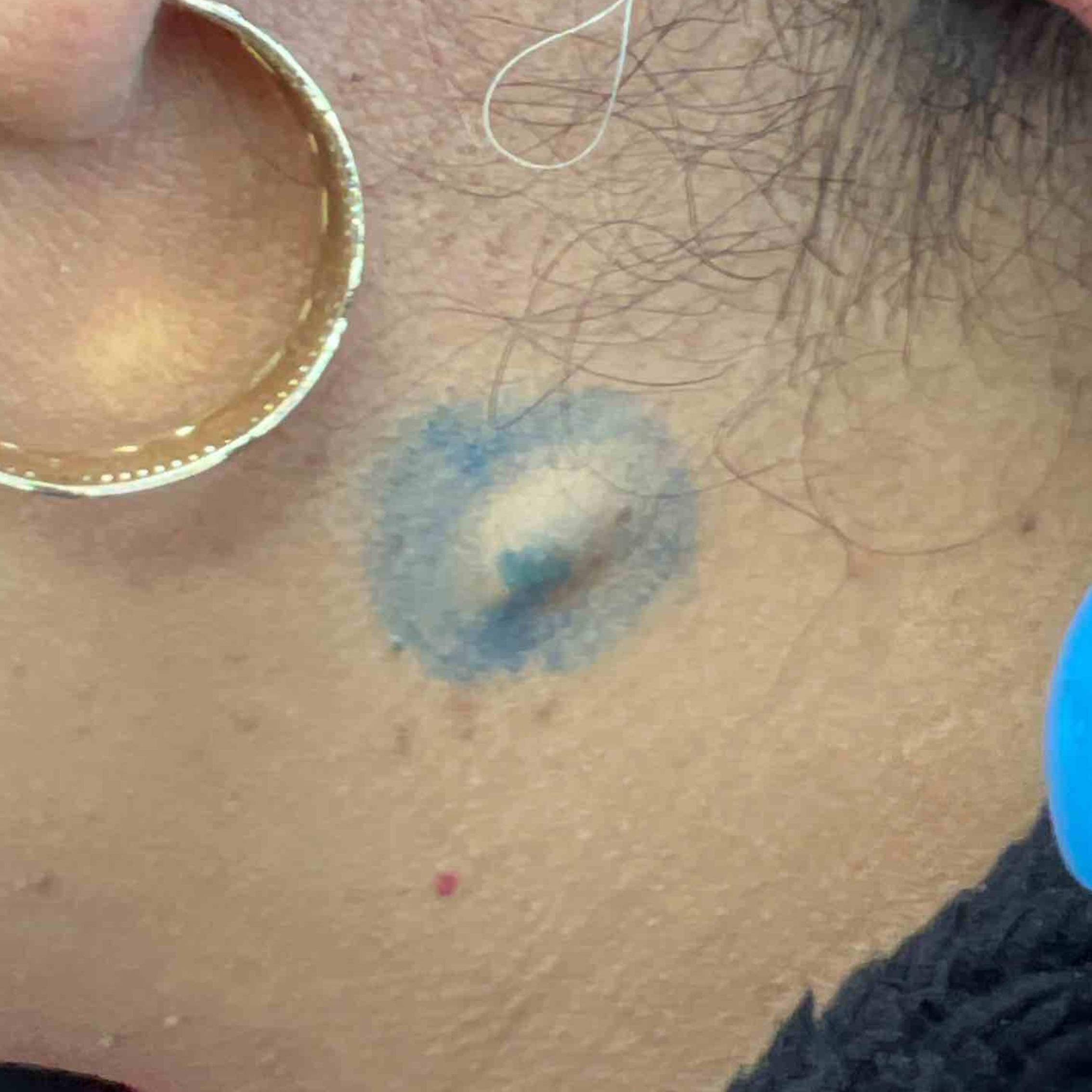 Cyst Removal Before and After Case-24 Before