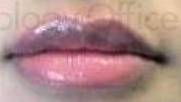 Juvederm (2 Syringes) Case 1 After
