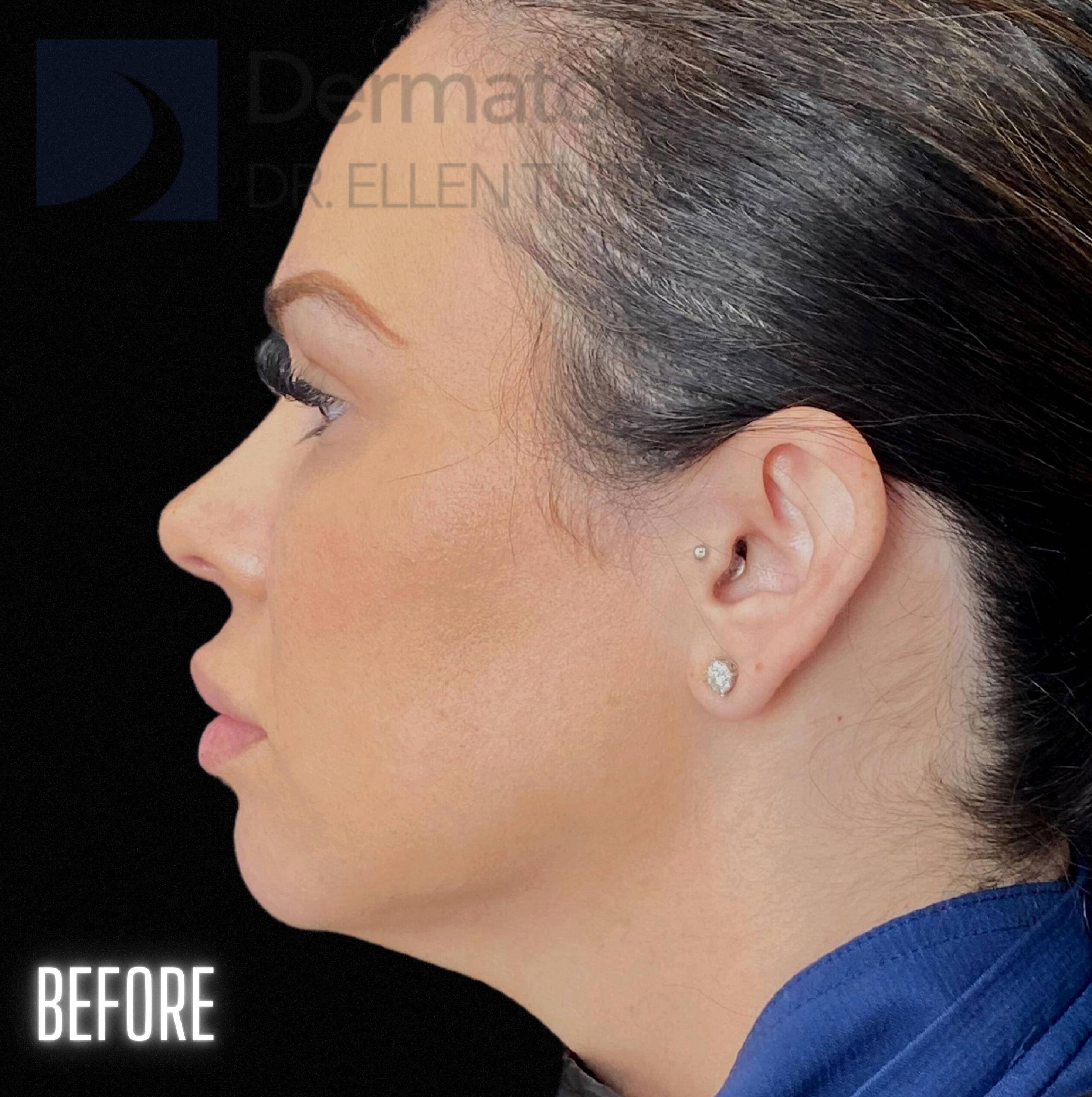 Snatch and Lift (4 treatments EMFACE and 4 syringes Volux XC) Before and After Case-2 Before