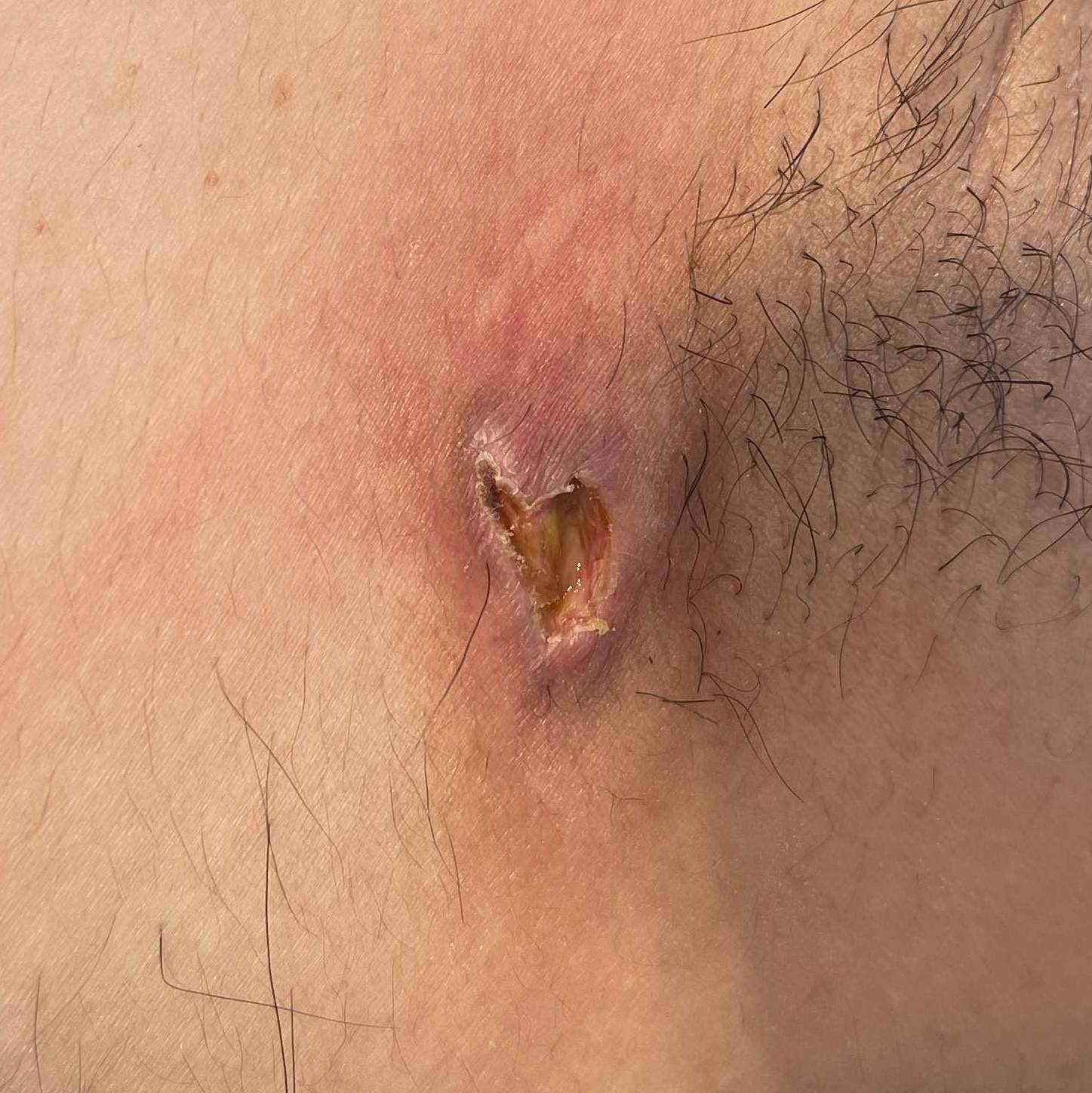 Cyst Removal Before and After Case-26 Before