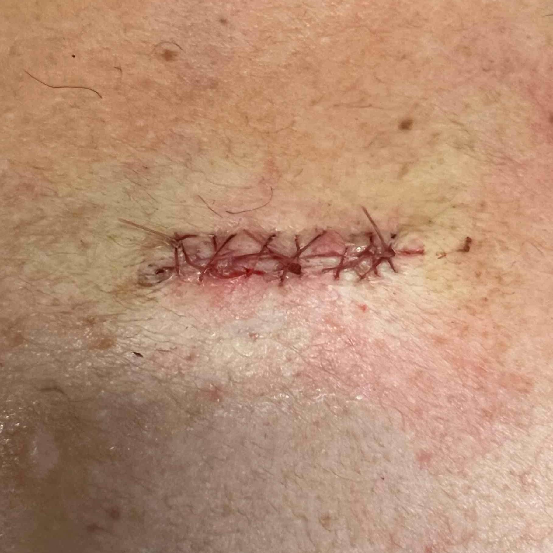 Cyst Removal Before and After Case-27 After