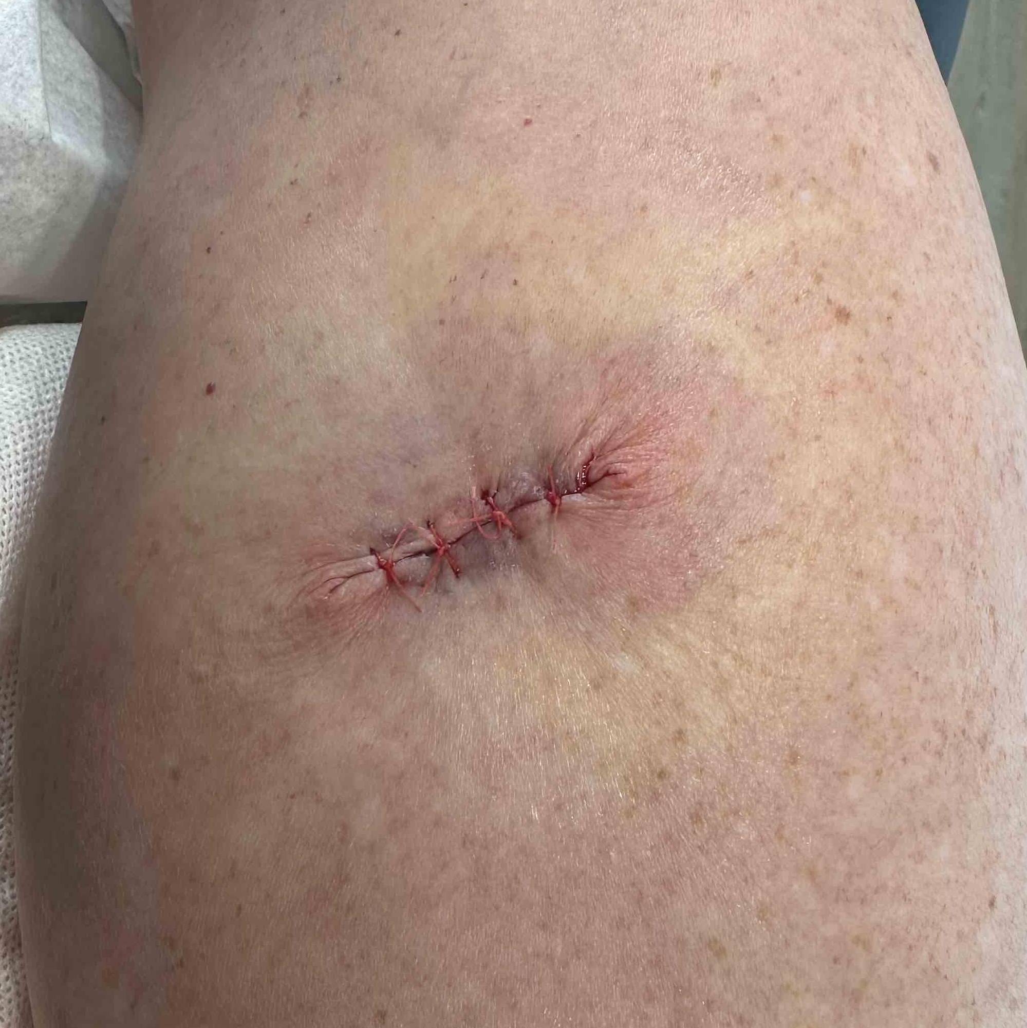 Cyst Removal Before and After Case-28 After