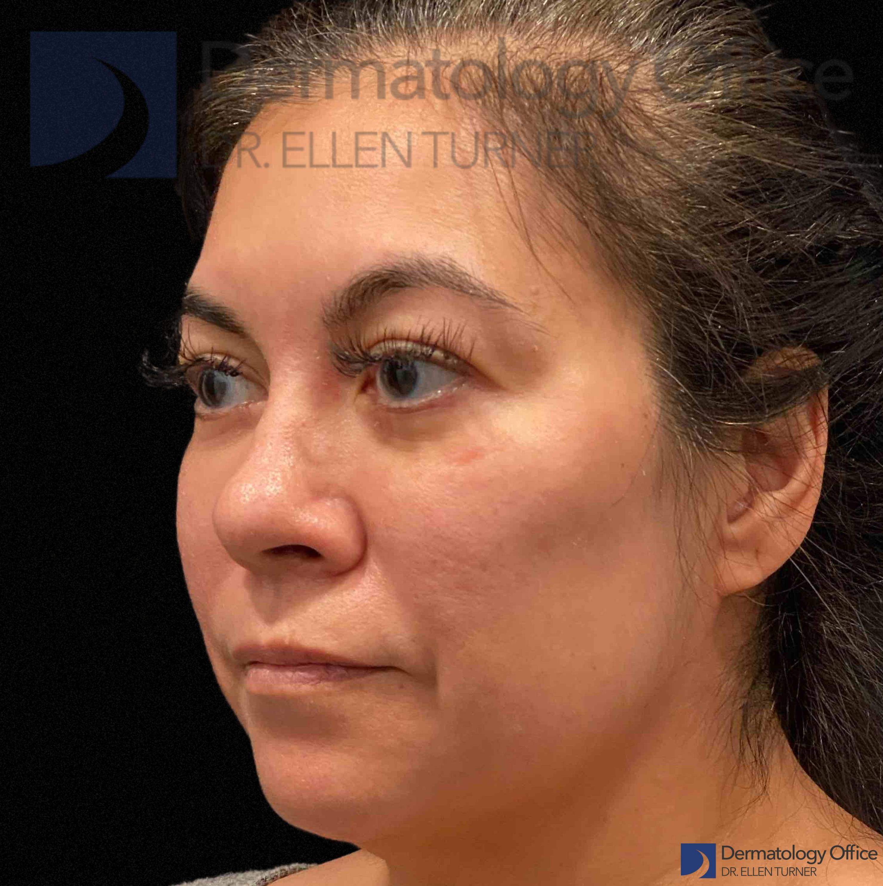 EMFACE (4 treatments) Before and After Case-59 After