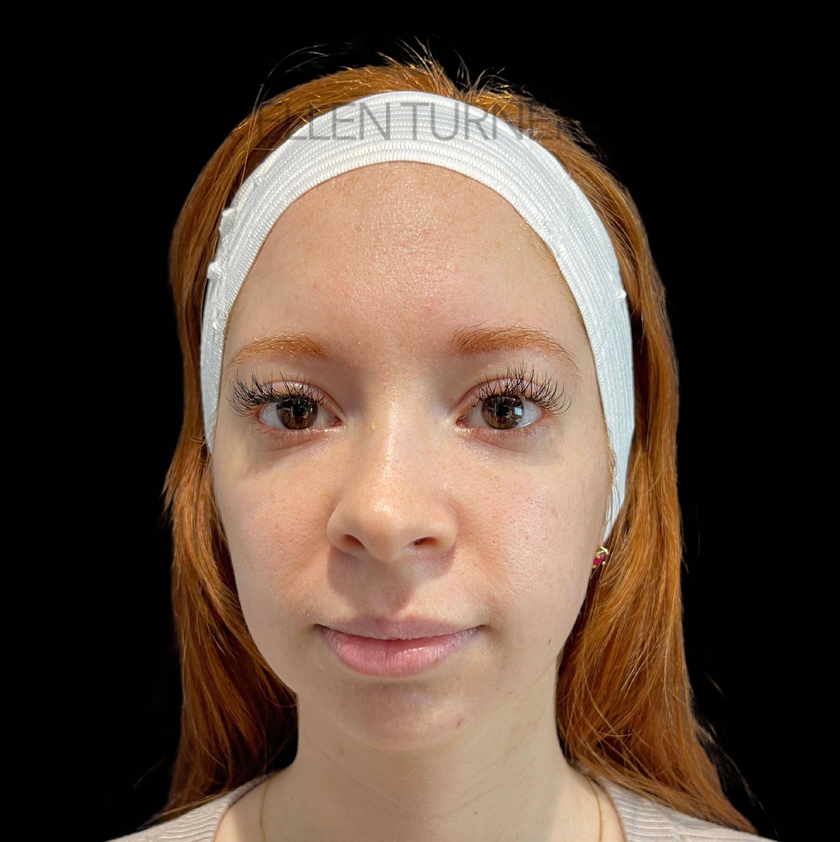Volux (4 syringes) Before and After Case-26 Before