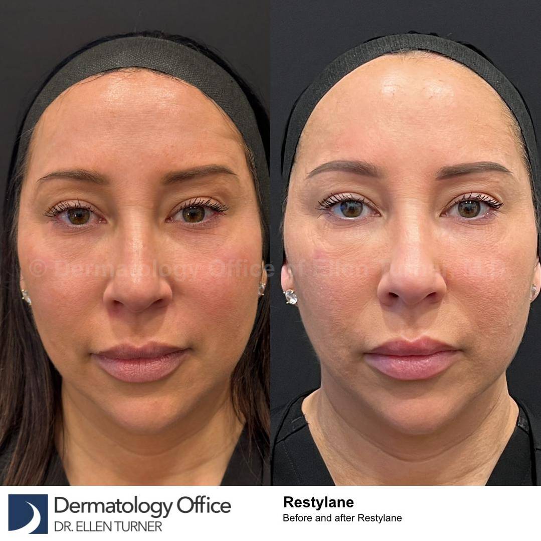 Restylane Before and After Case 11 