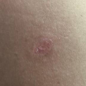 Skin Cancer Before and After Case 6 After