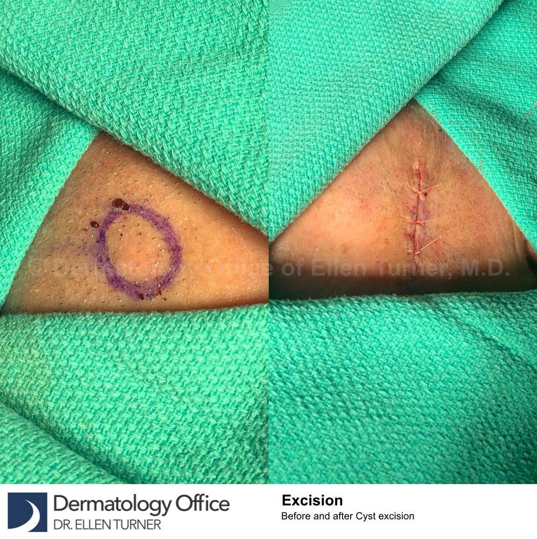 Cyst Removal Before and After Case-52 