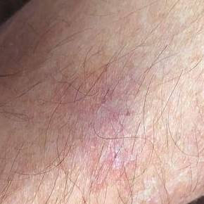 Skin Cancer Before and After Case 8 After