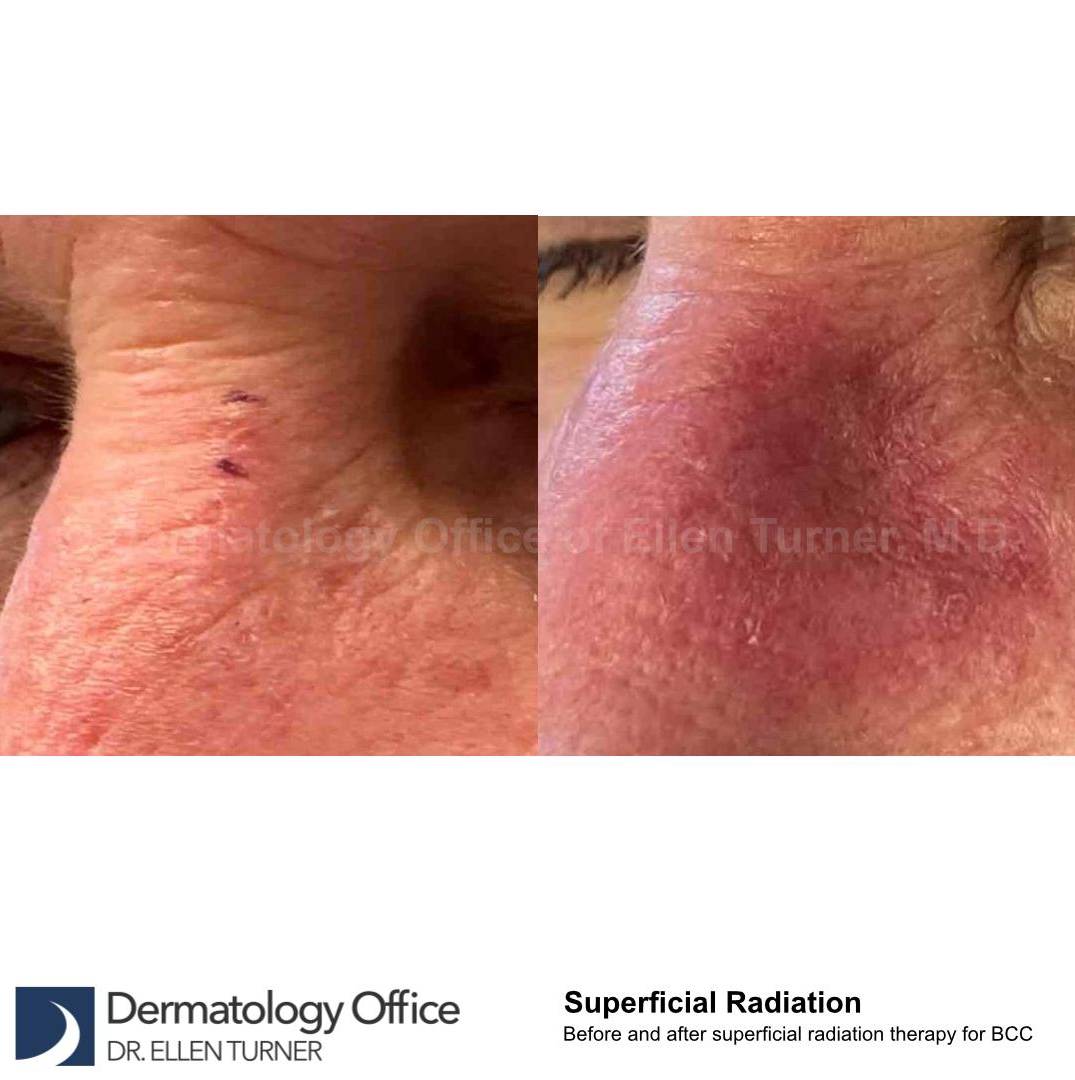 SRT-100 Before and After Case 23 