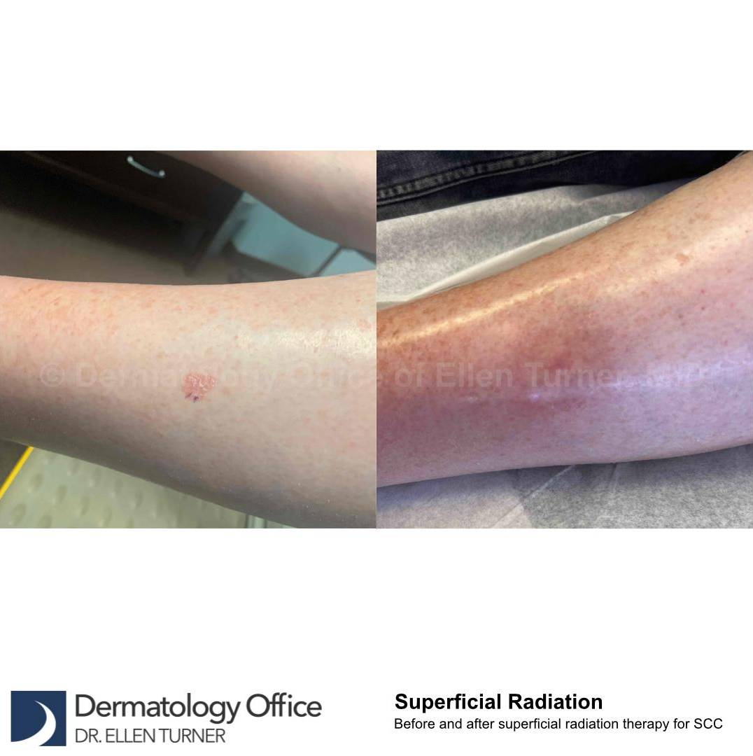 SRT-100 Before and After Case 39 
