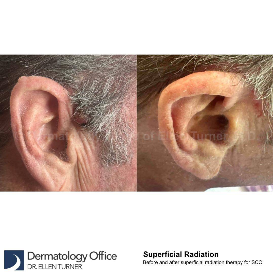 SRT-100 Before and After Case 43 