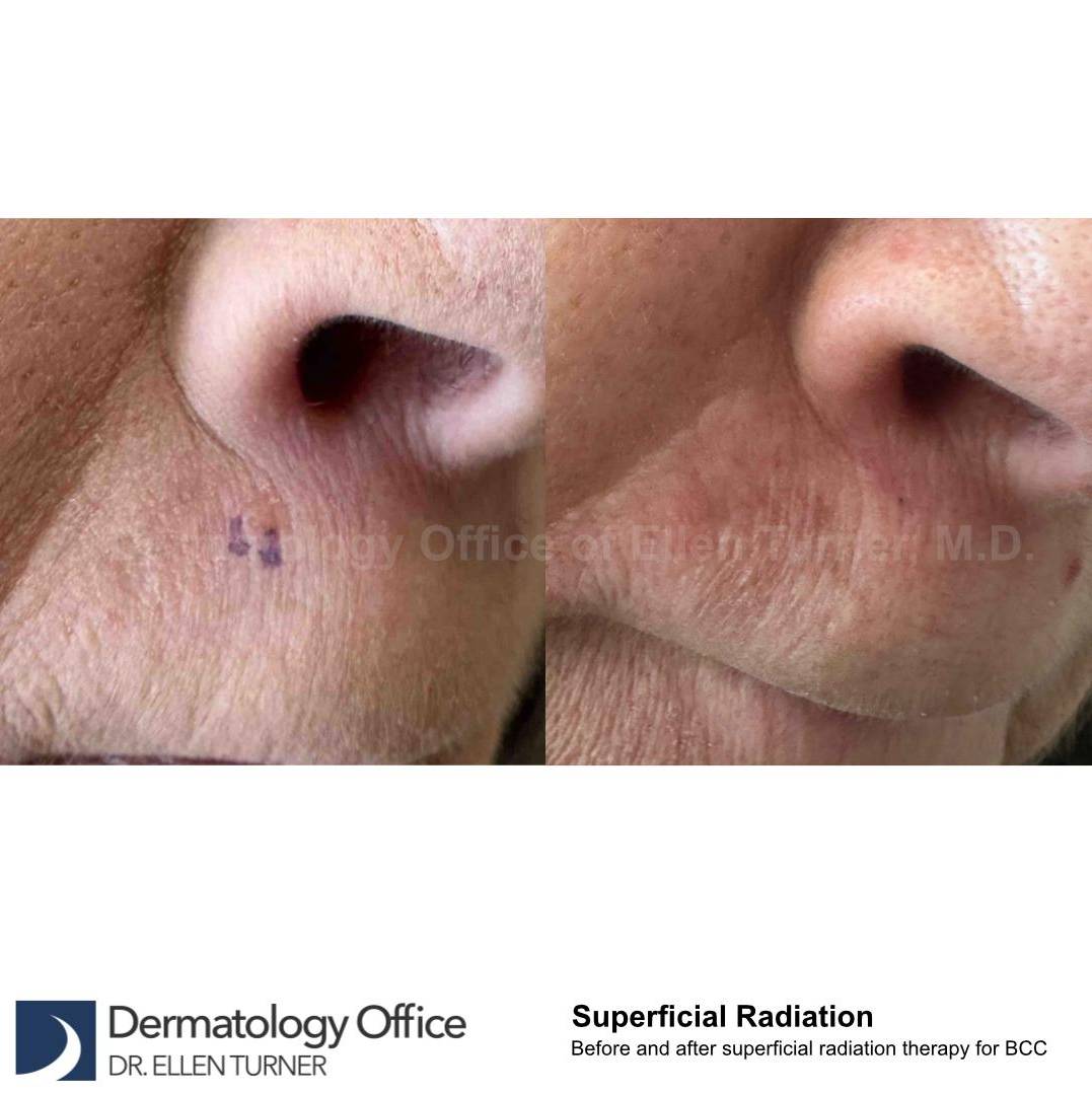 SRT-100 Before and After Case 53 