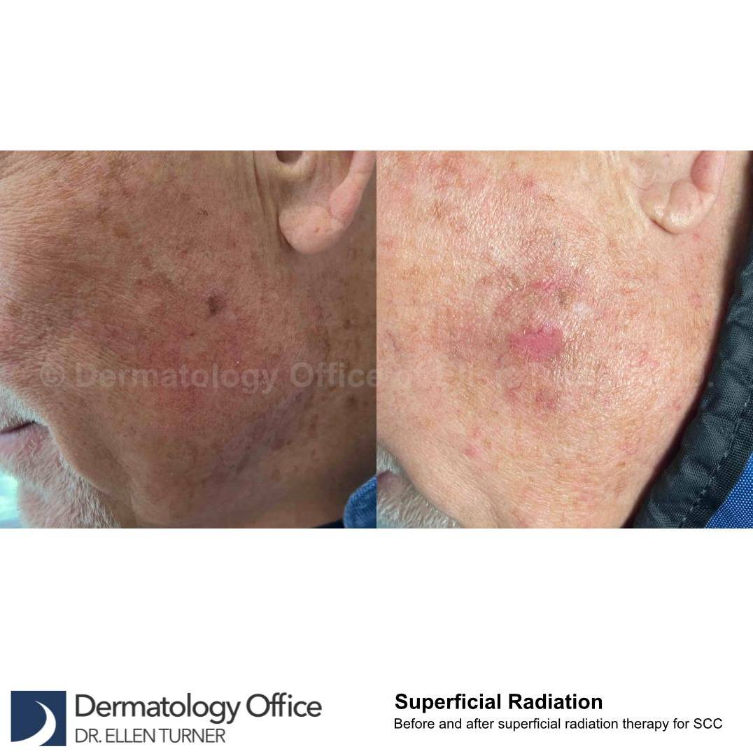 SRT-100 Before and After Case 57 