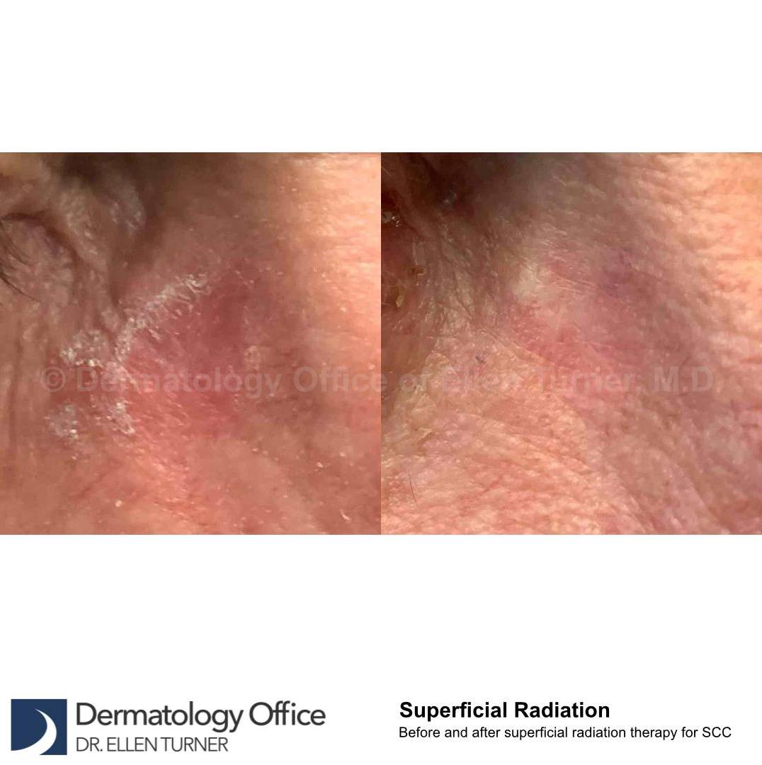 SRT-100 Before and After Case 58 