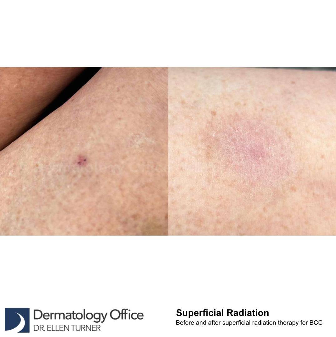 SRT-100 Before and After Case 59 