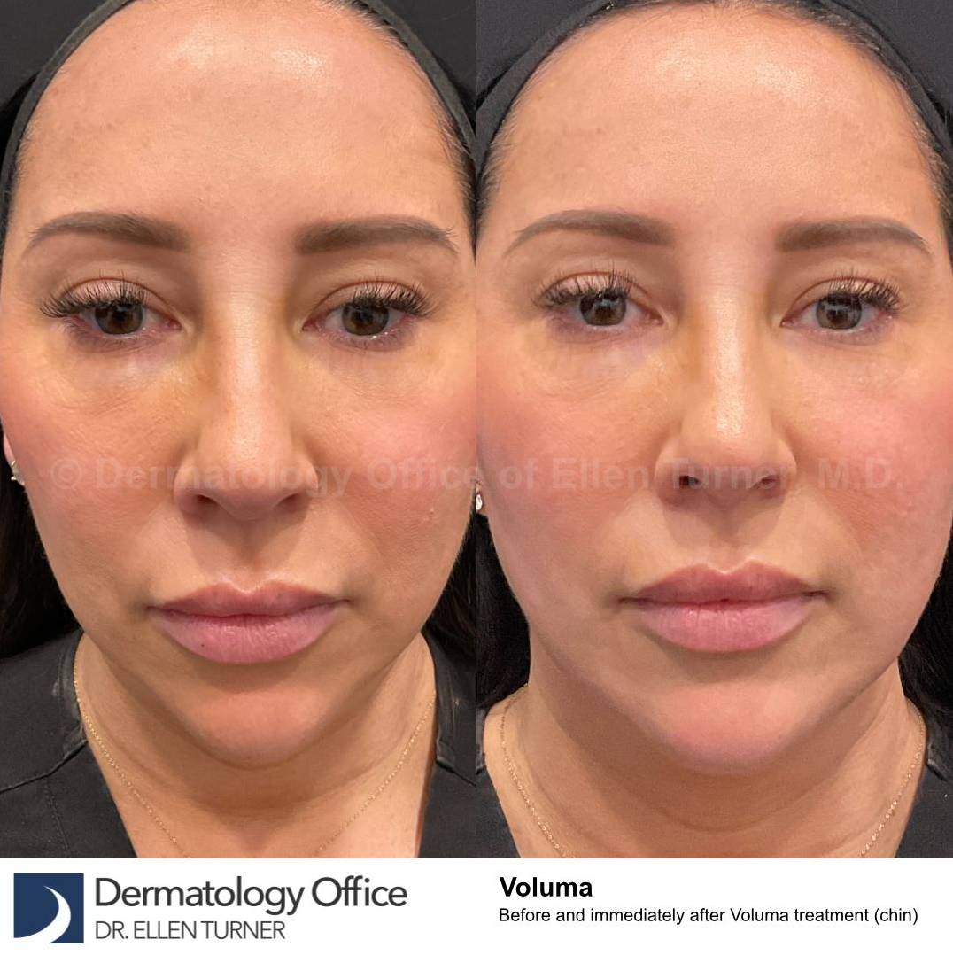 Before and After Voluma Case 24 