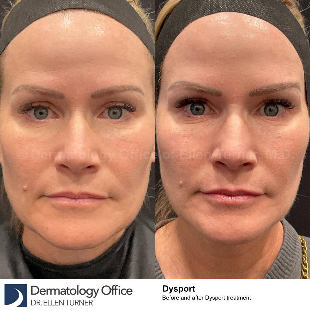 Dysport Before and after Case-5 
