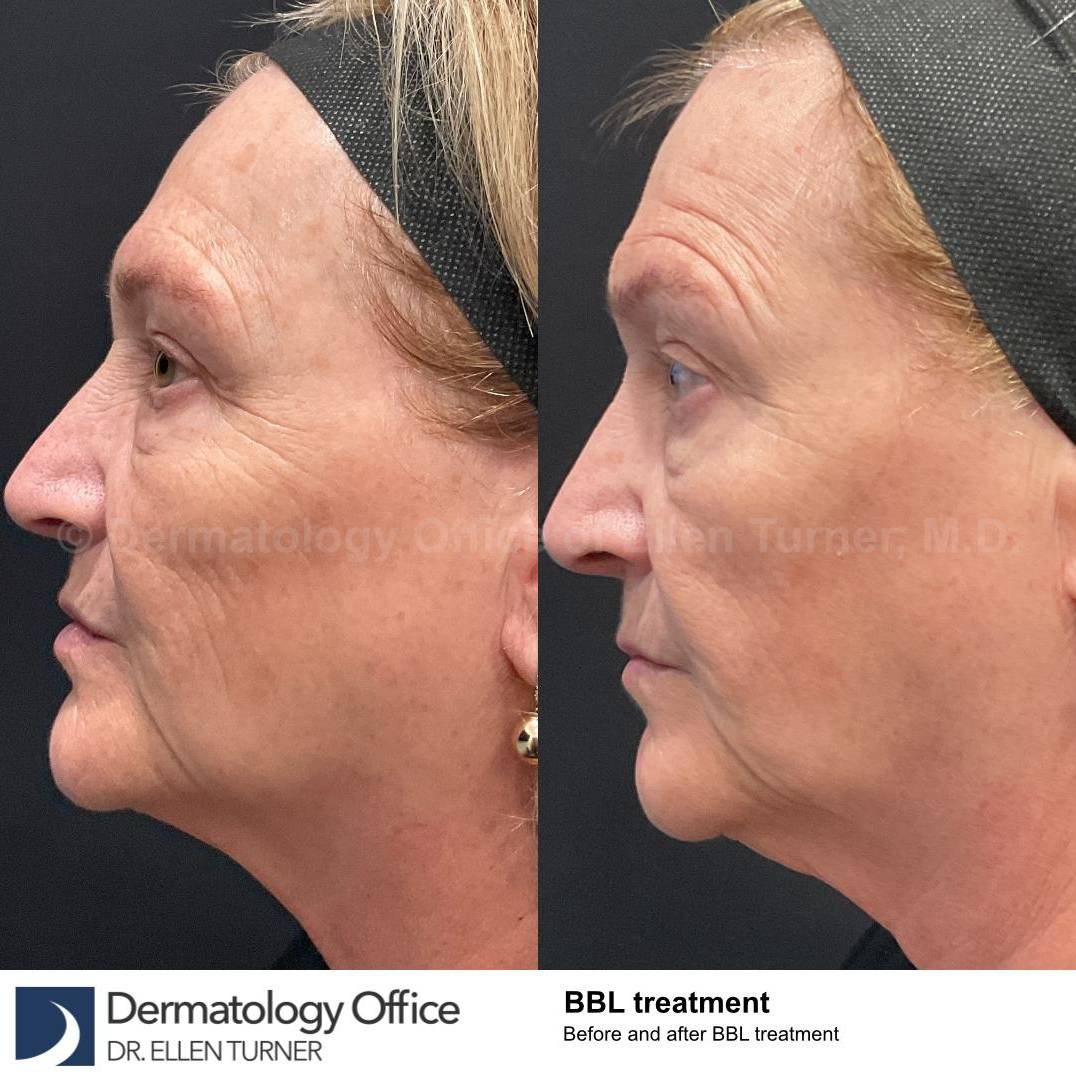 IPL-Photofacial/BBL BroadBand Laser Case-12 