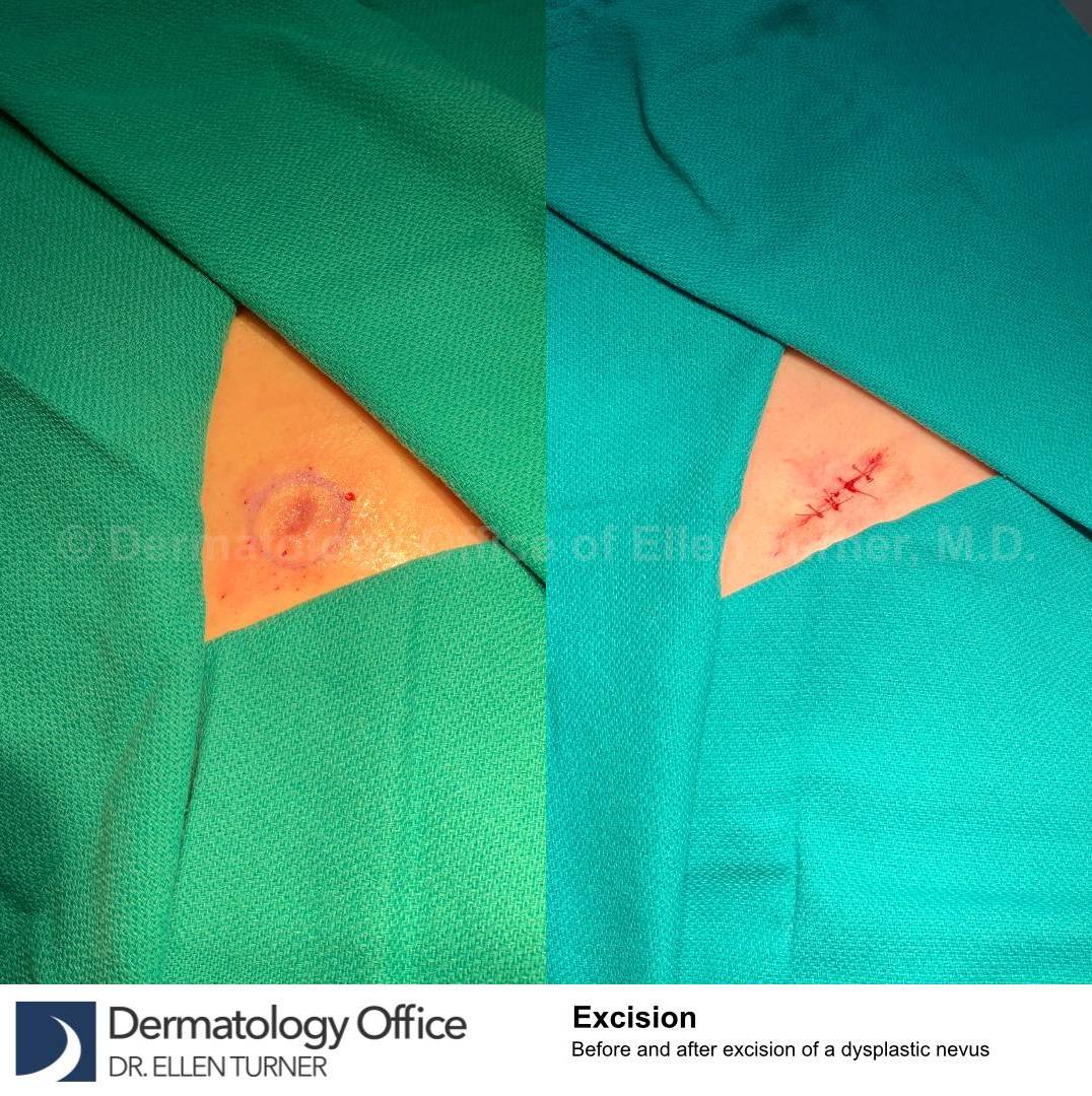 Skin Cancer (Excision) Case-93 
