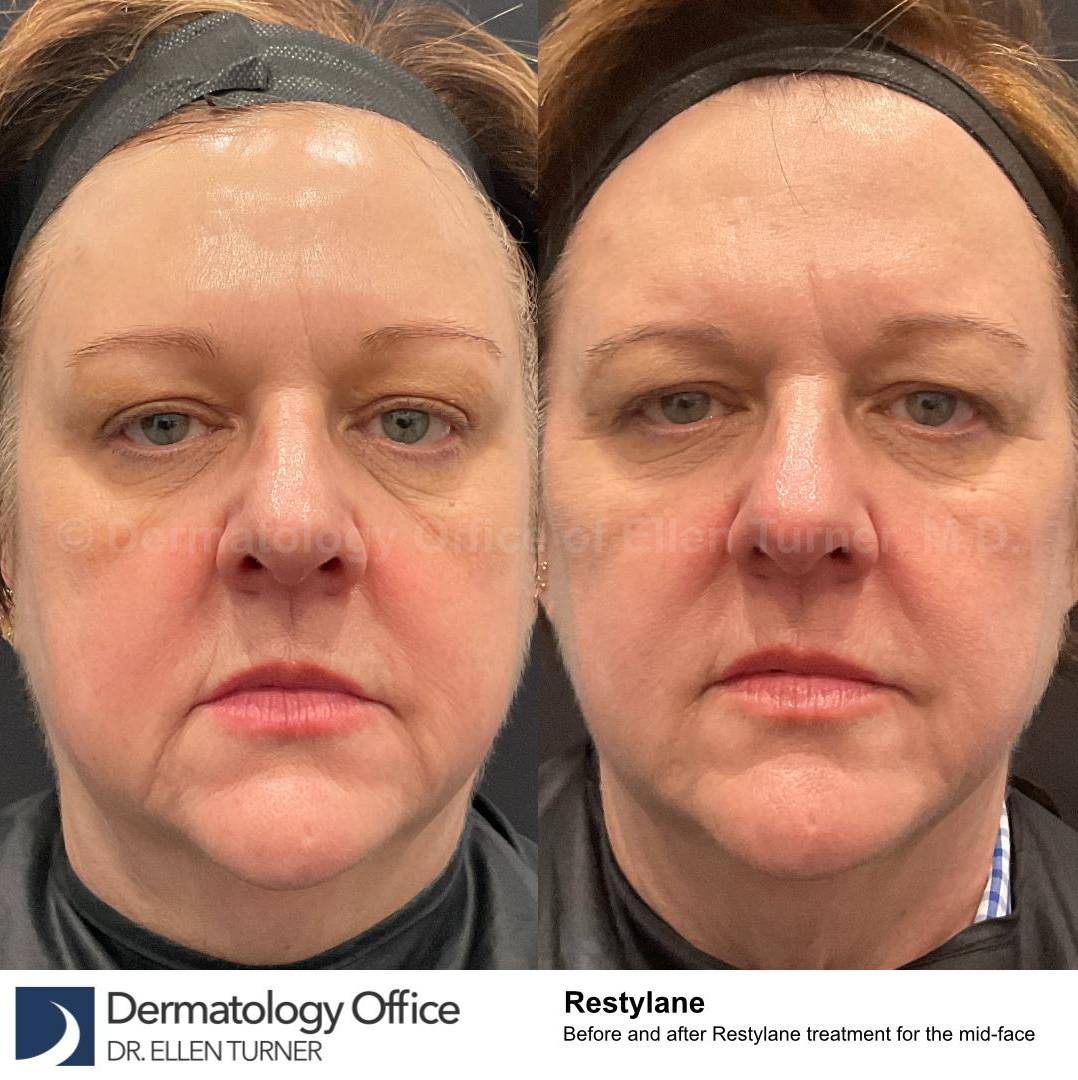 Restylane Before and After Case 26 