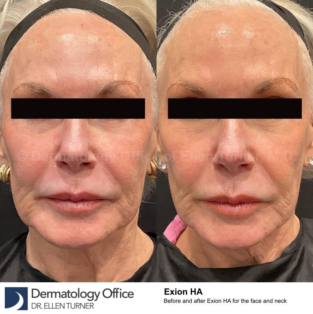 Exion HA Before and After Case 1 
