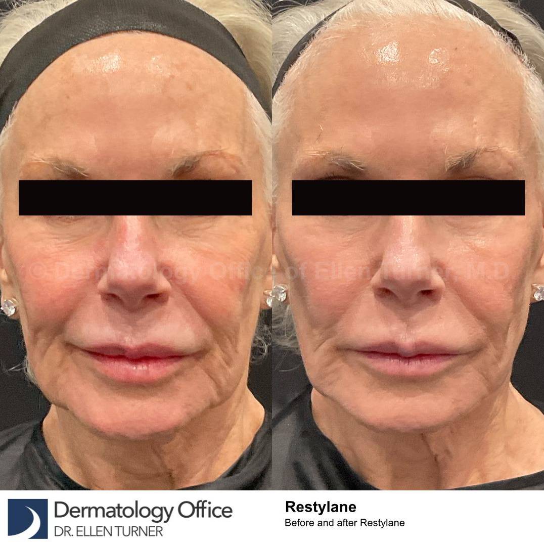 Restylane Before and After Case 28 