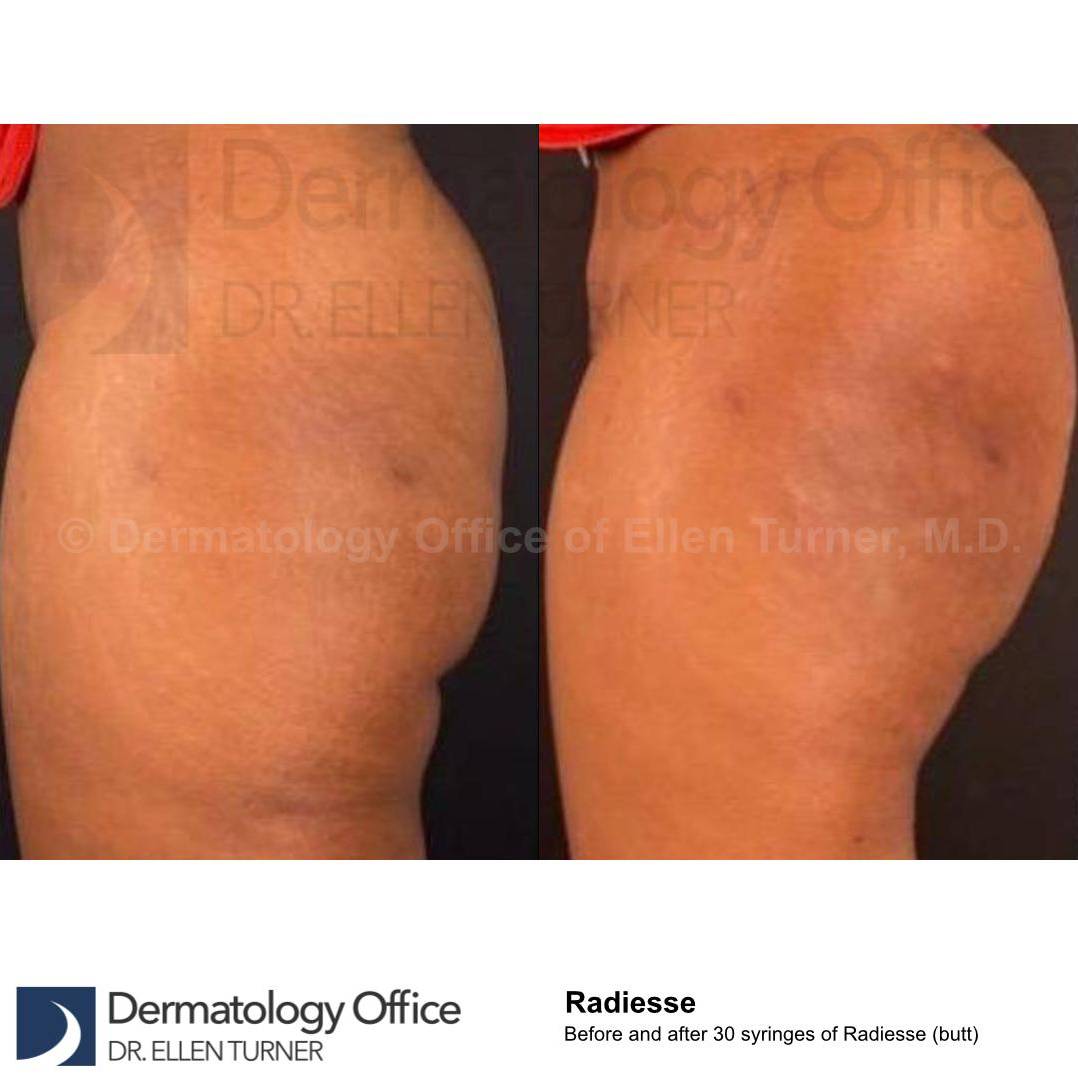 Radiesse Butt Augmentation (30 Syringes) Case 1 