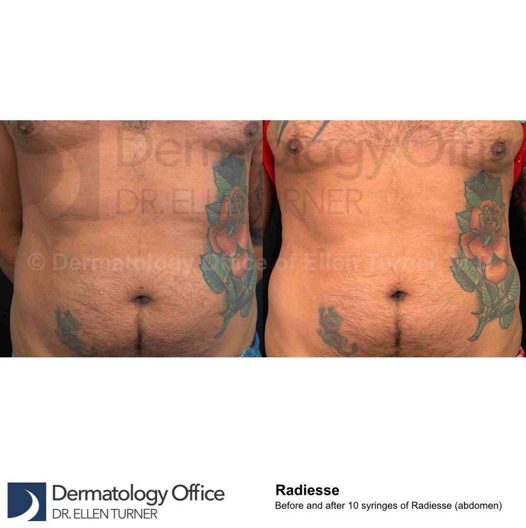 Radiesse Abdomen (10 Syringes) Case 4 