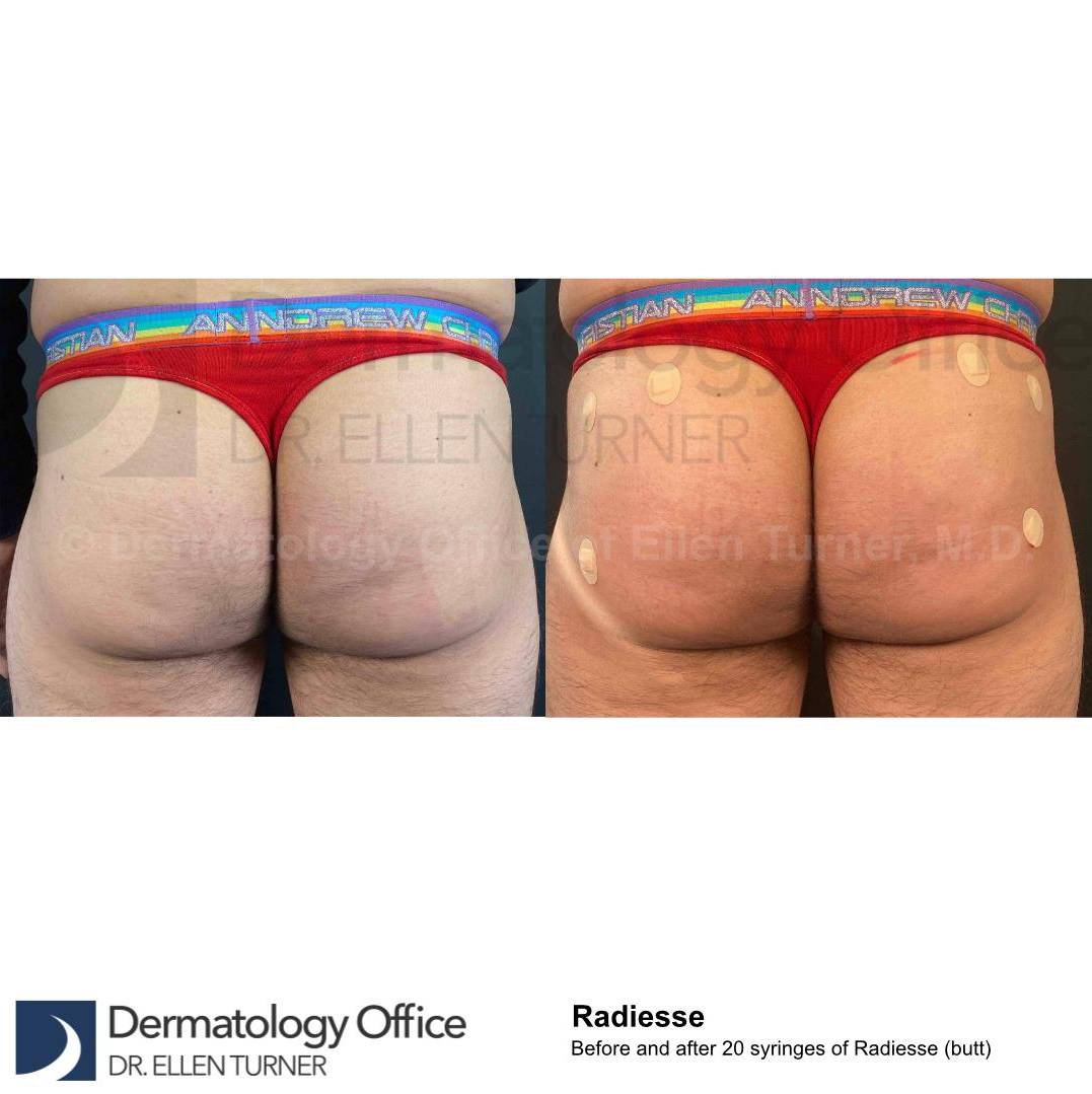 Radiesse (20 Syringe) Case-10 