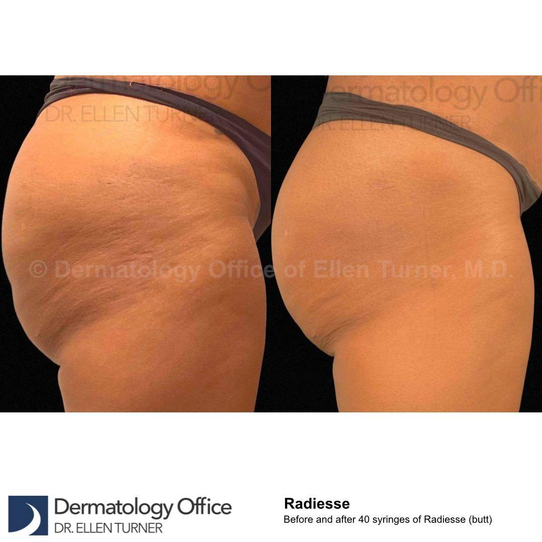 Radiesse Before and After Case 19 