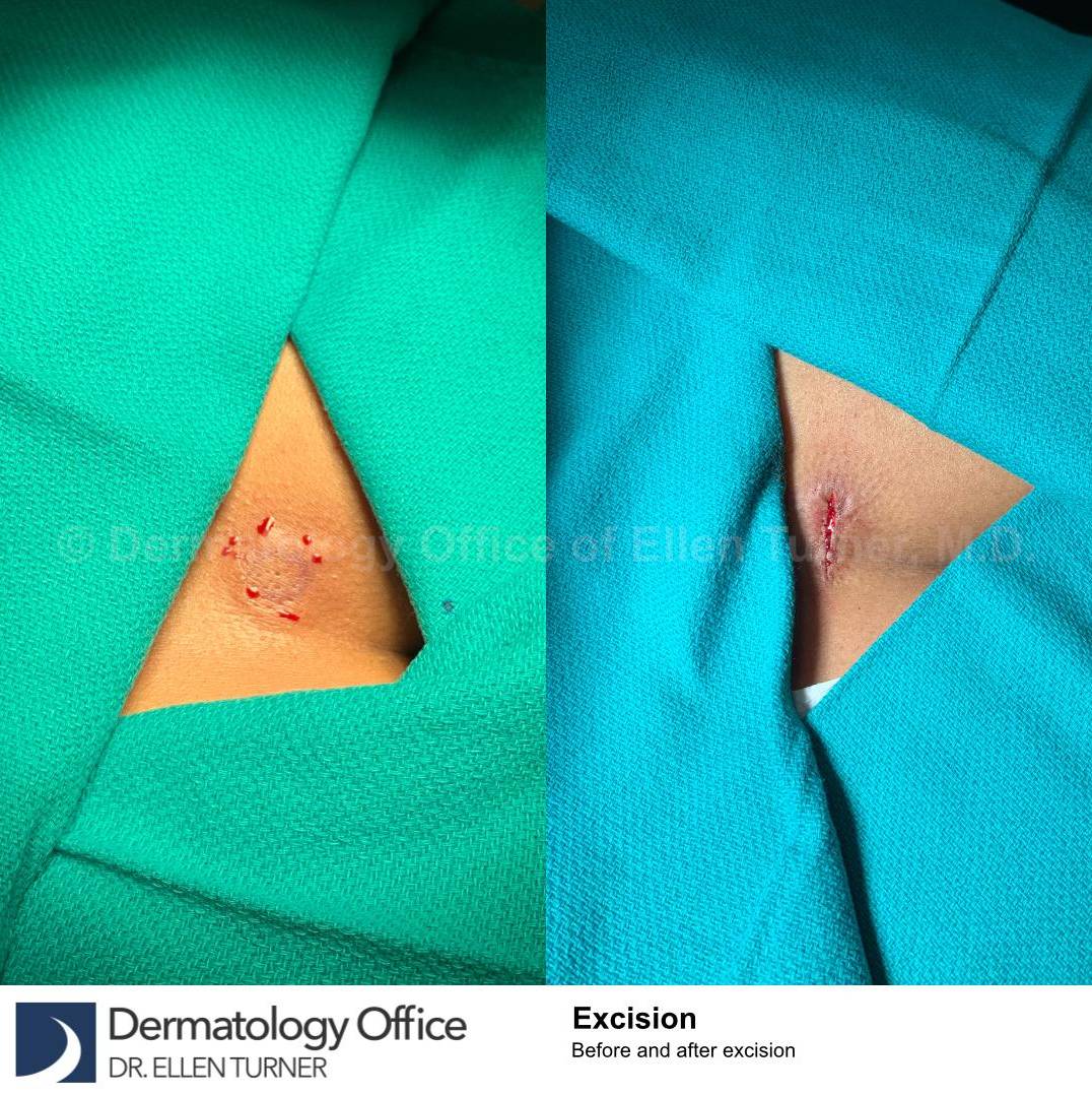 Skin Cancer (Excision) Case-97 