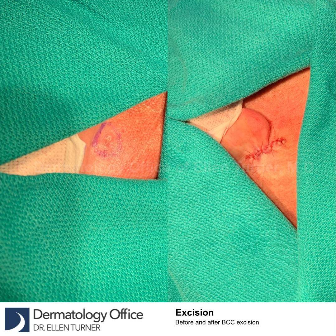 Skin Cancer (Excision) Case-102 