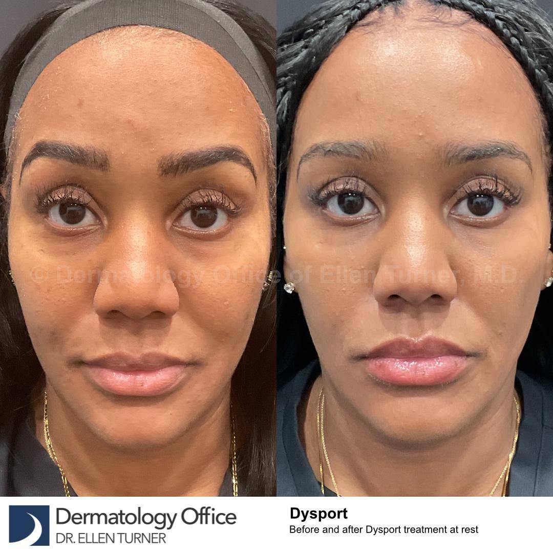Dysport Before and after Case-7 