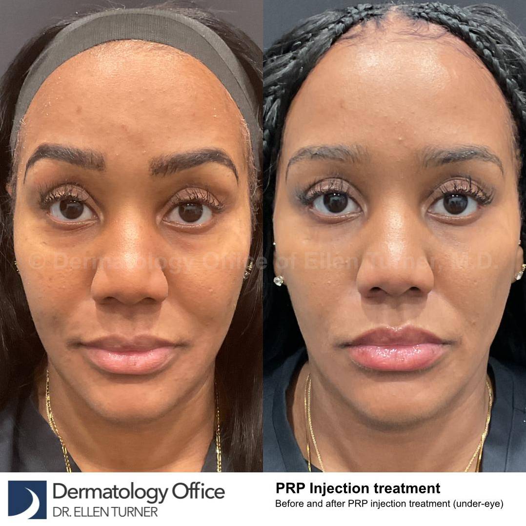 Platelet-Rich Plasma Before and After Case 10 