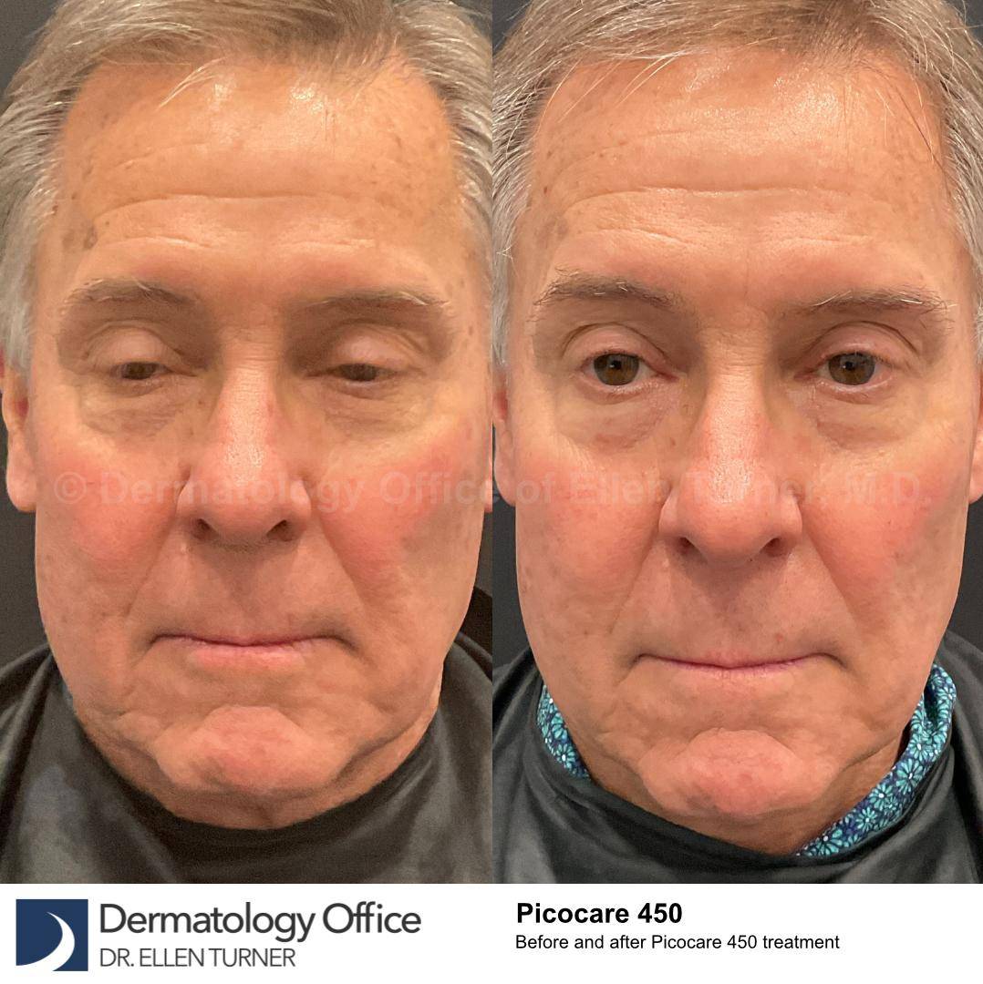 Picocare 450 Before and After Case-9 