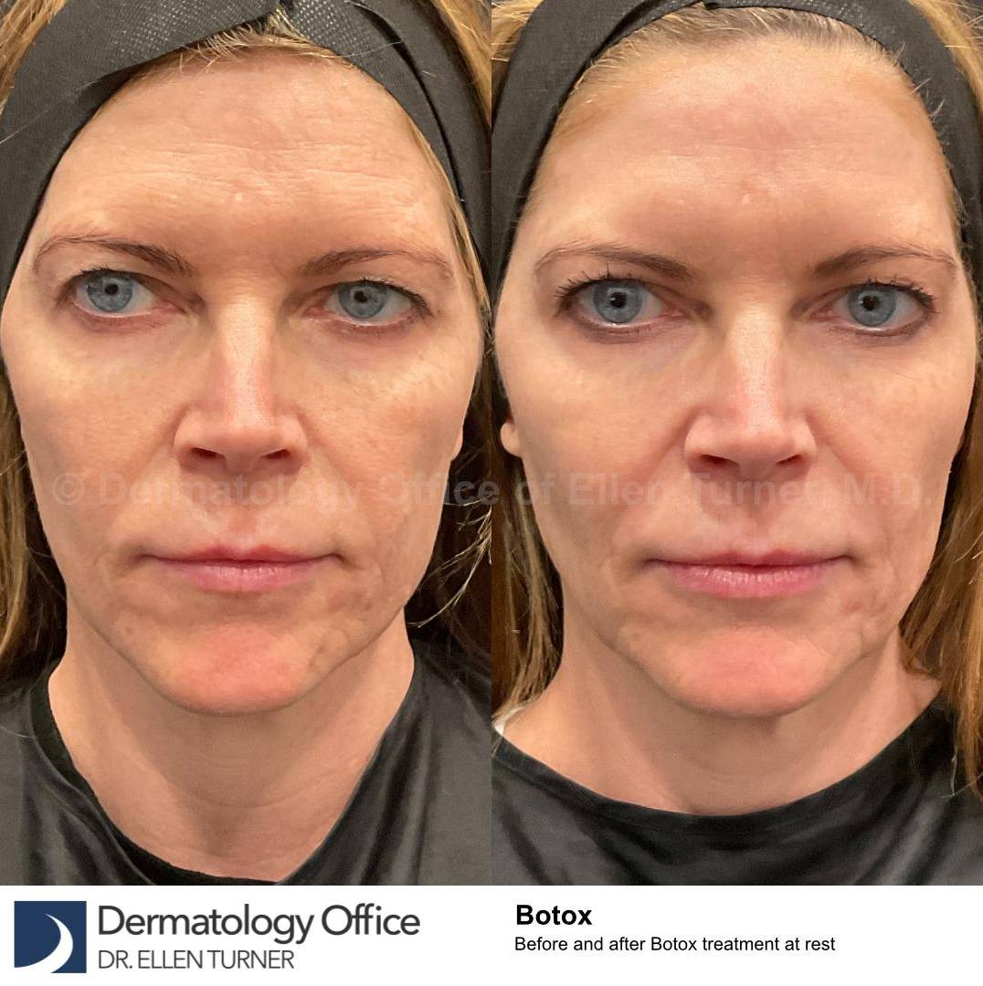 Botox Case 23 