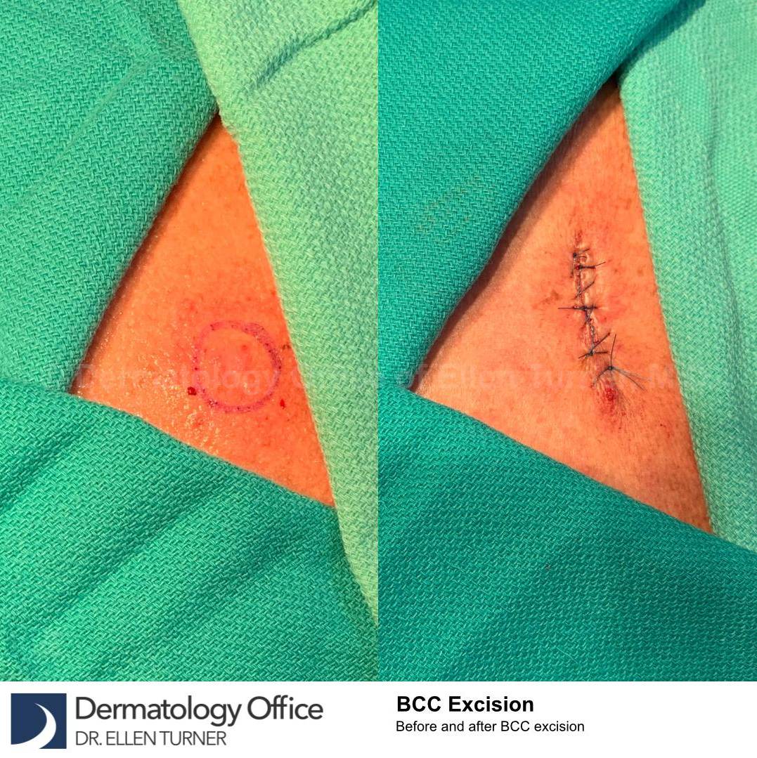 Skin Cancer (Excision) Case-104 