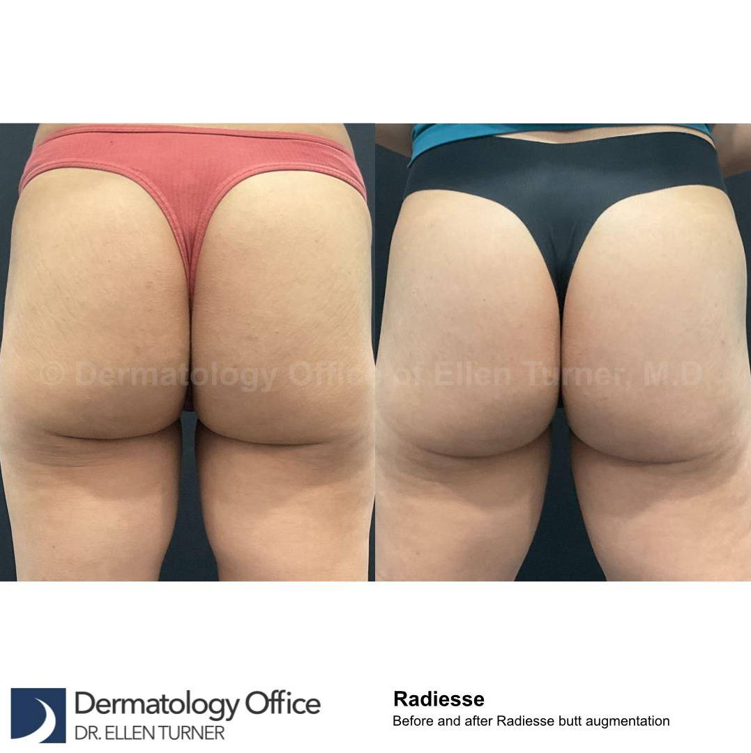 Radiesse Before and After Case 20 