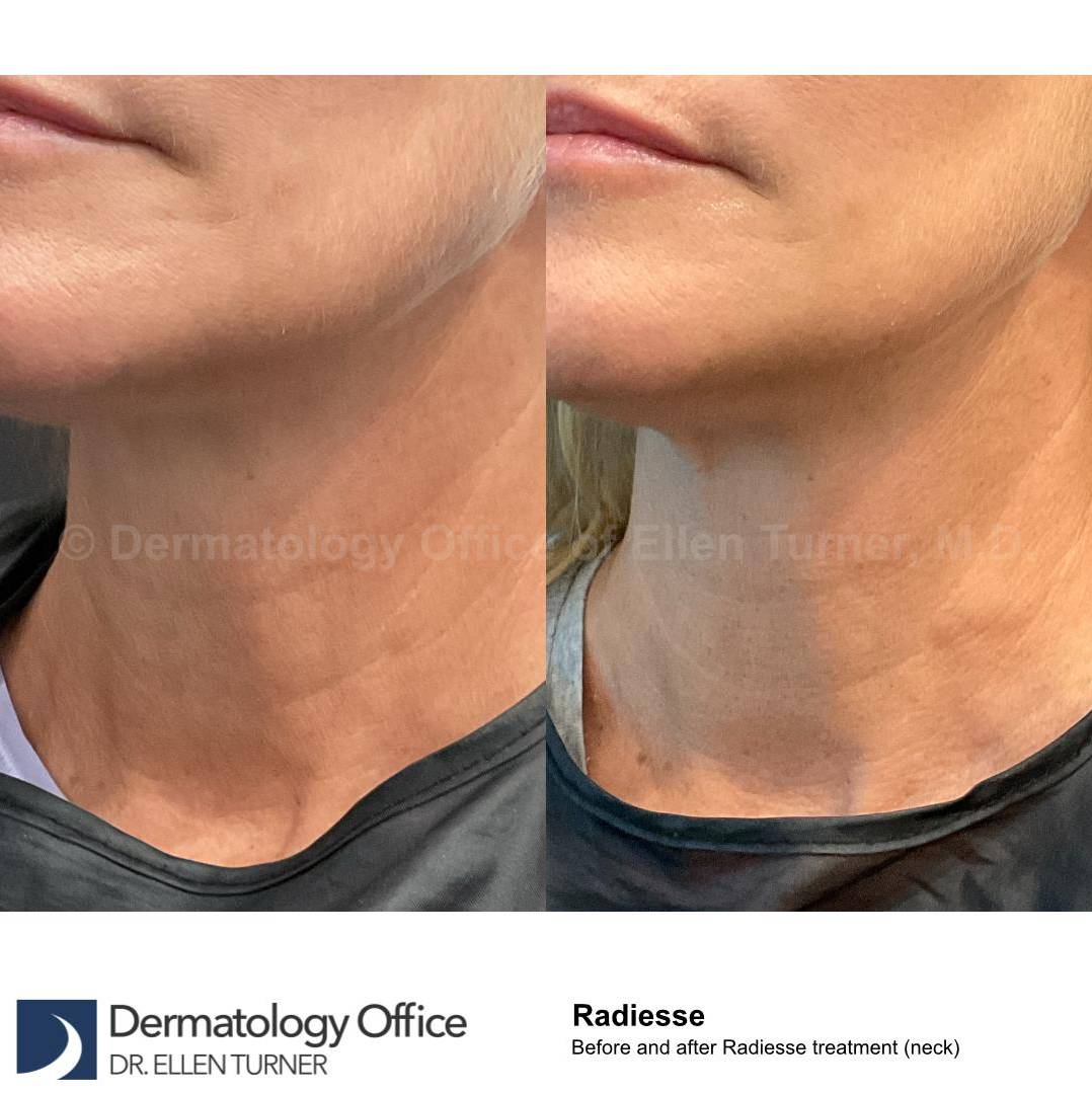 Radiesse Before and After Case 21 