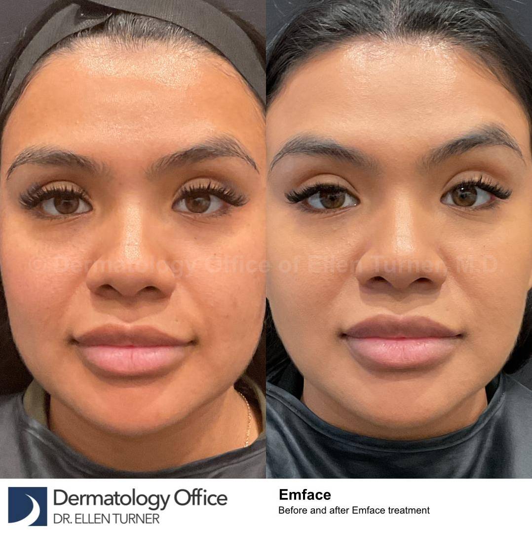EMFACE Before and After-63 